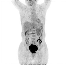 上新了 | PET-CT“引路”，肿瘤诊疗更精准